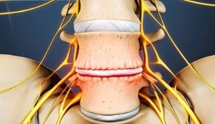 interspinozna artroza