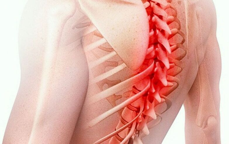 osteohondroza torakalne kralježnice