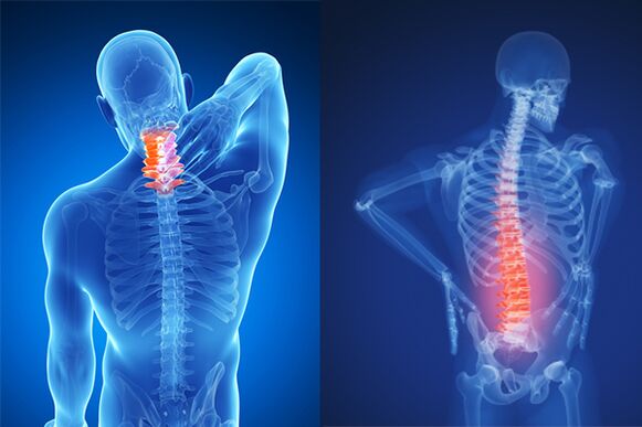 Osteokondroza cervikalne i lumbalne kralježnice