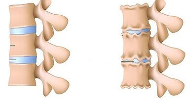 Kako prepoznati prisutnost osteohondroze lumbara