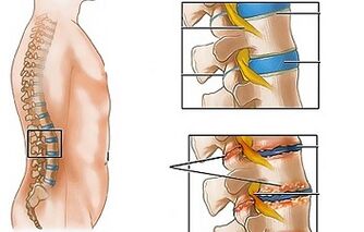 Uzroci osteohondroze lumbalnog